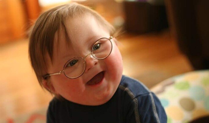 Down Sendromu nedenleri