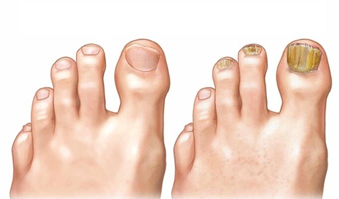 Tırnak Mantarı belirtileri