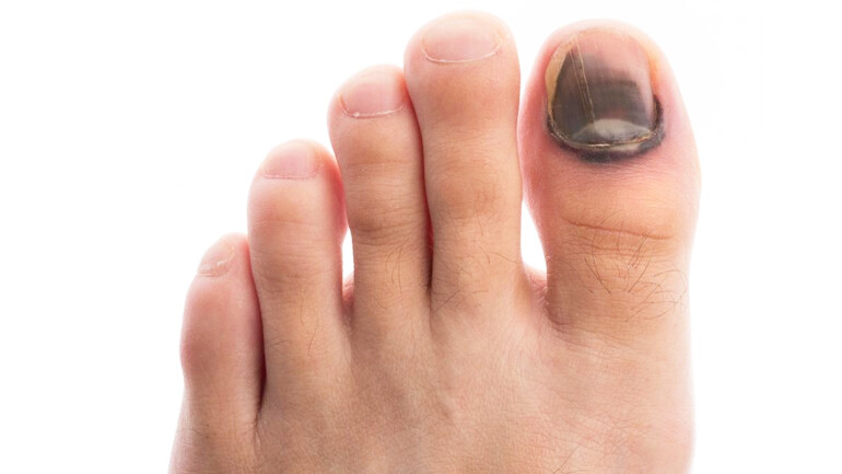 Tırnak Mantarı nasıl geçer