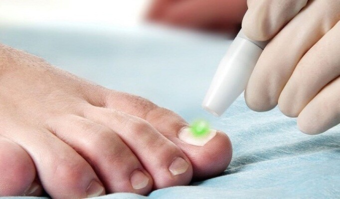 Tırnak Mantarı tedavisi