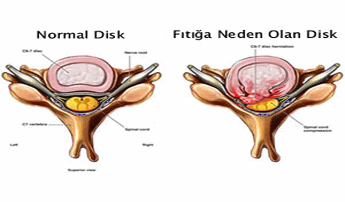 Boyun Fıtığına neden olan disk
