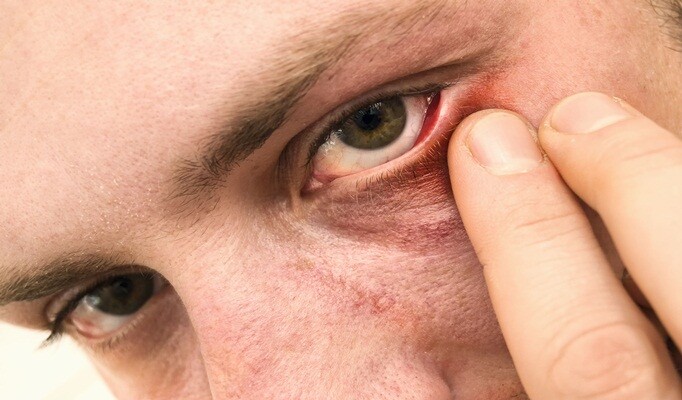 Göz Nezlesi belirtileri