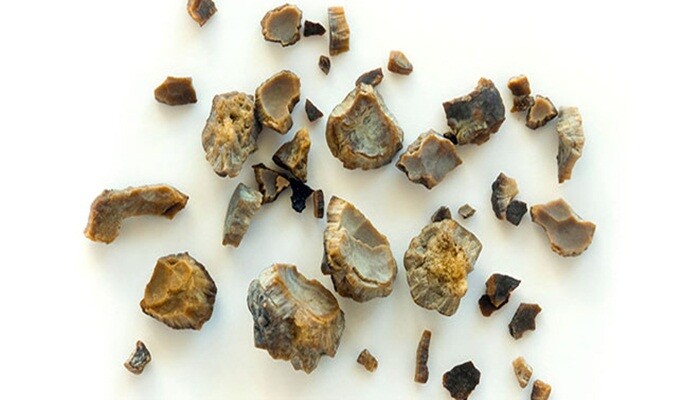 Böbrek Taşı nedir