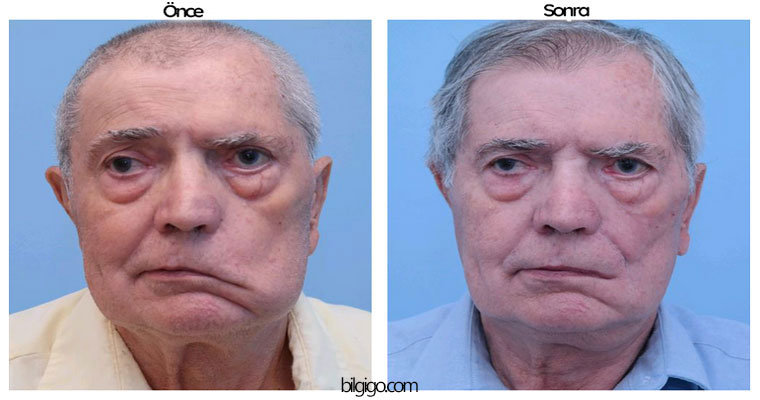 yüz felci değişim