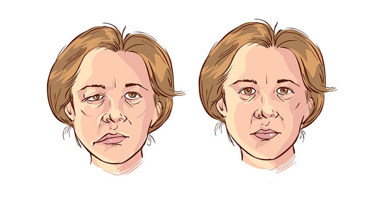 Yüz Felci Nedir? Nedenleri, Belirtileri ve Tedavisi