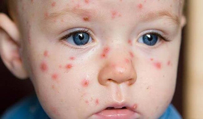 Su Çiçeği Hastalığı