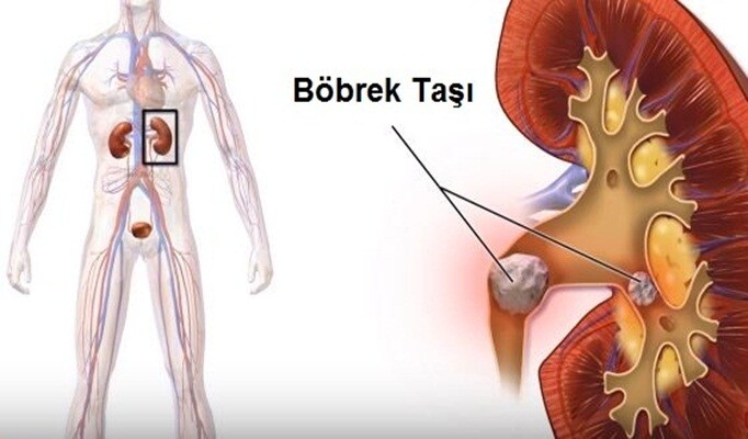 Böbrek Taşı belirtisi