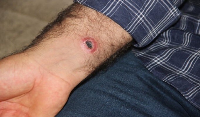 şarbon hastalığı nedir