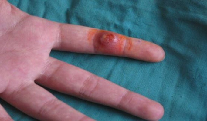 şarbon hastalığı tedavisi